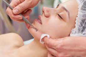 Acne Scars and Esthetician Extractions