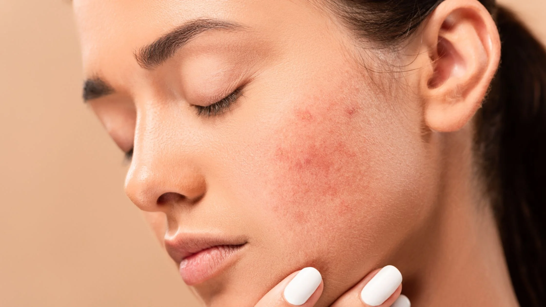 Reduce Acne Scarring: Proven Home and Professional Treatments