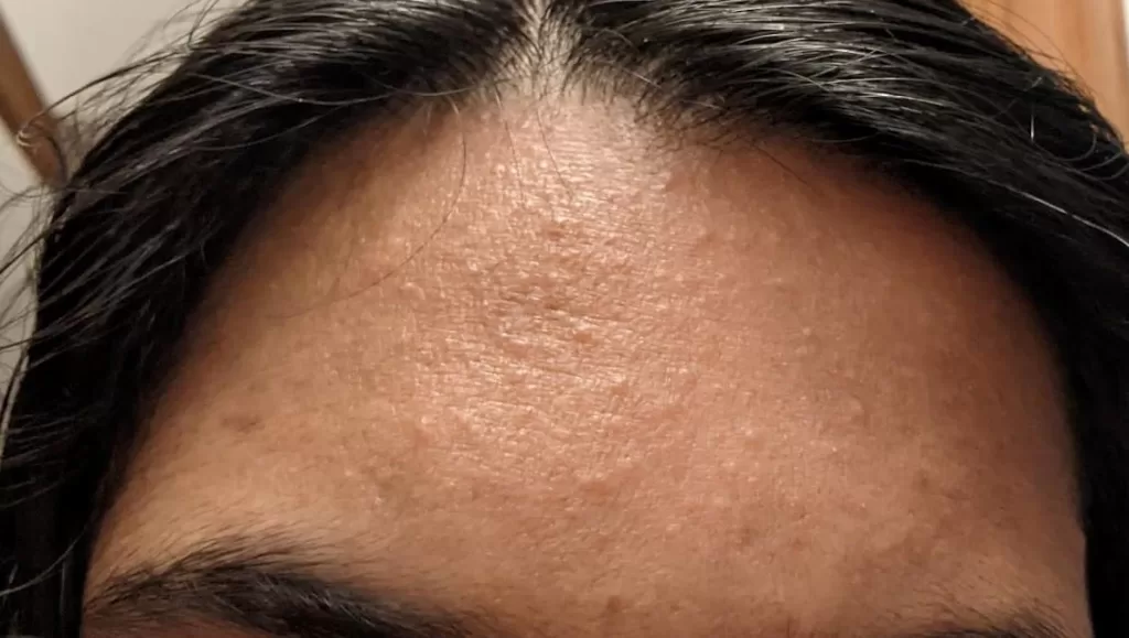 Where And How Resources Forehead bumps treatment