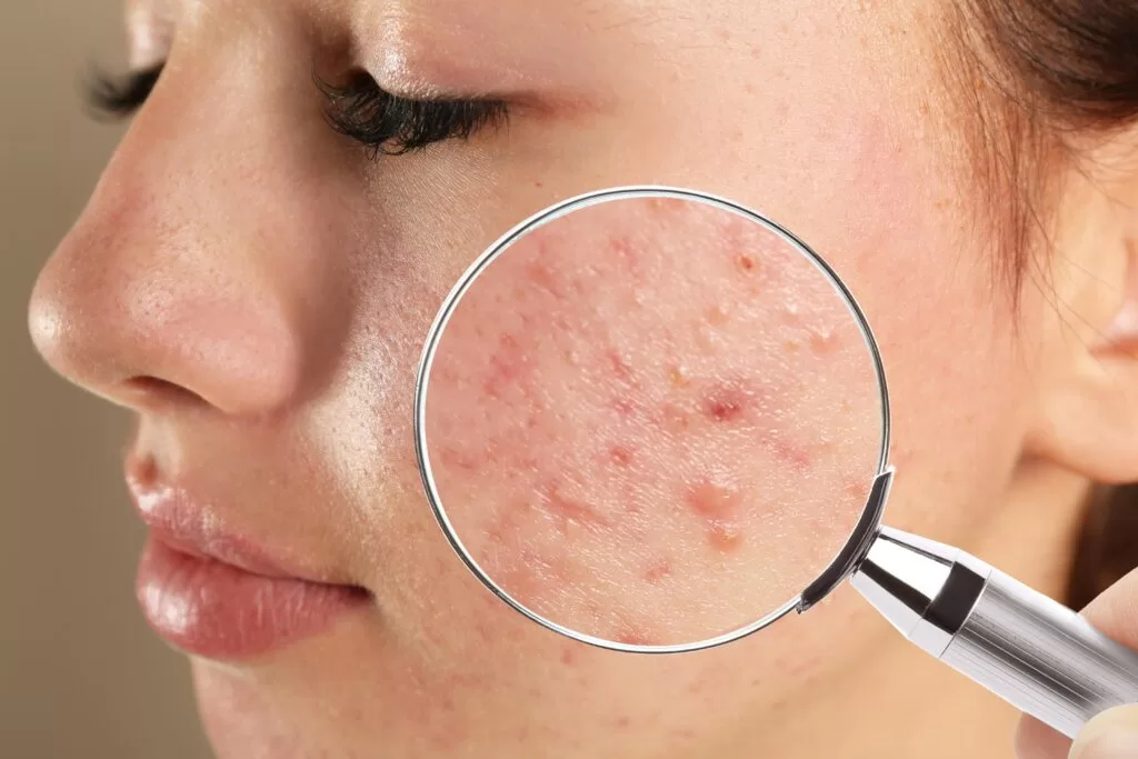 Close-up of a young woman, acne-prone skin,. products including benzoyl peroxide, retinoids, and salicylic acid."