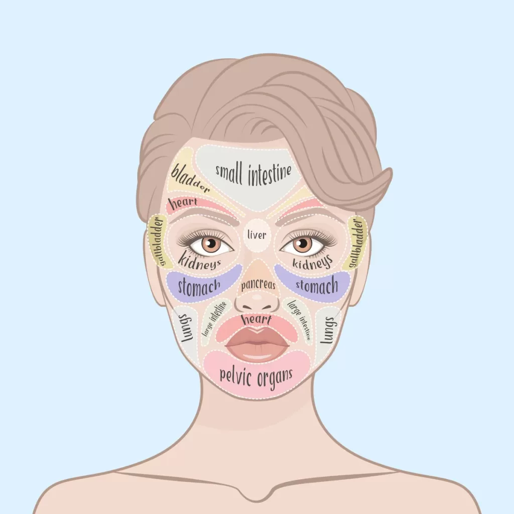 Image of Hormonal Acne face map