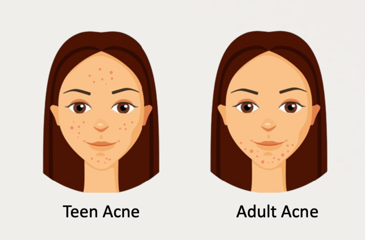 Image of Teen acne, Adult acne