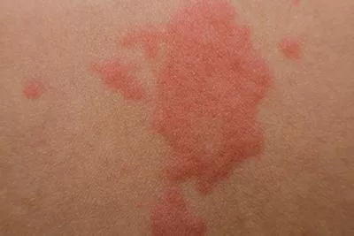 Image of red skin: Calm red irritated skin