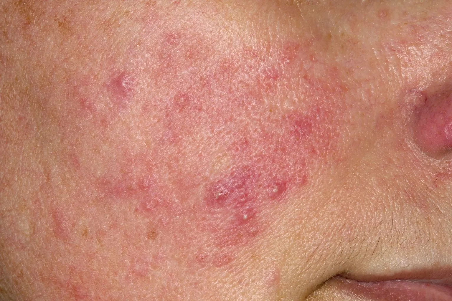 Image of a face:Treat rosacea and control redness