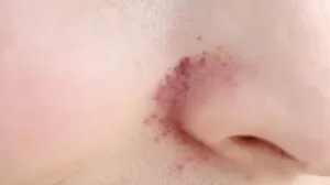 Image of Redness near nose