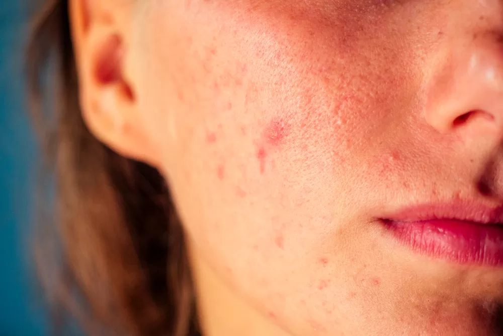 Image of a face showing, Skincare for stress-prone skin