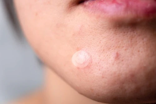 Image of a face using the product Pimple patches