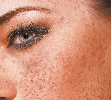 Image of a woman'face: breakthrough for melasma treatments