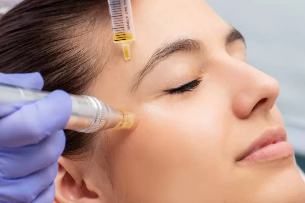 Microneedling for Hyperpigmentation